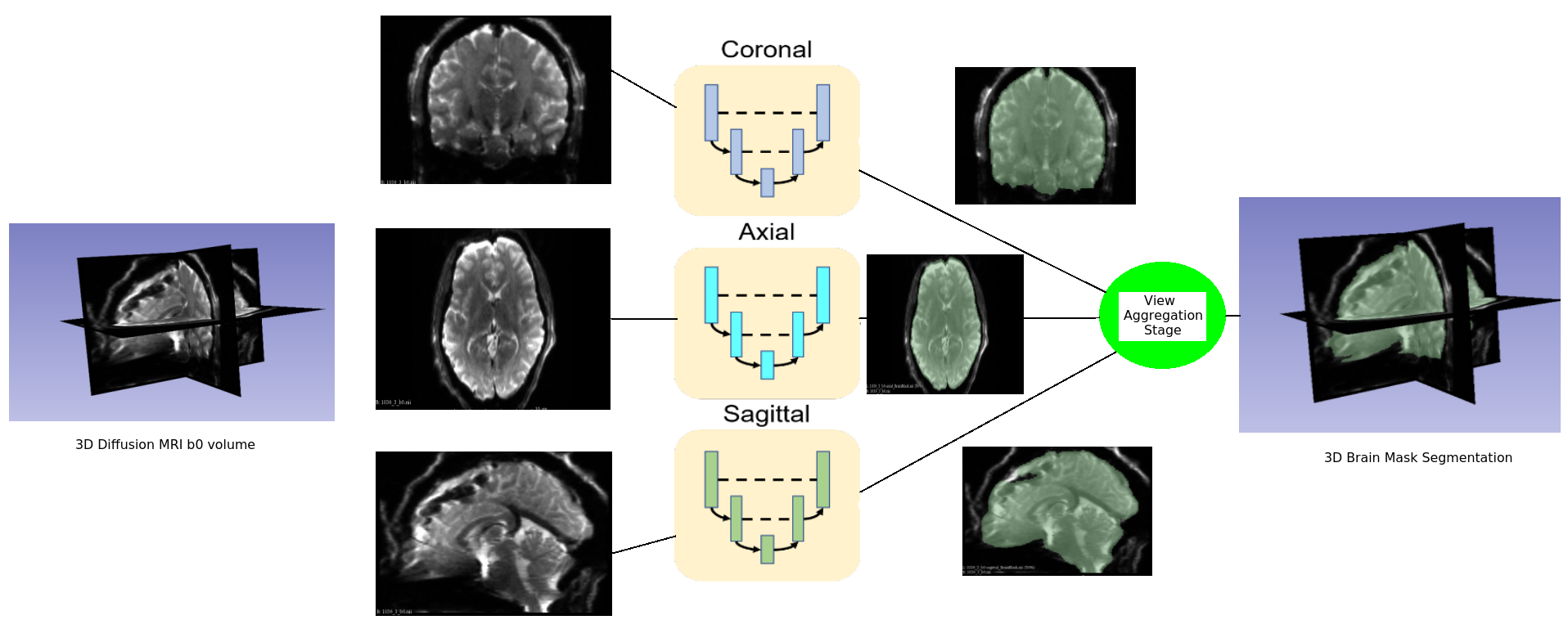 CNN-Diffusion-MRIBrain-Segmentation